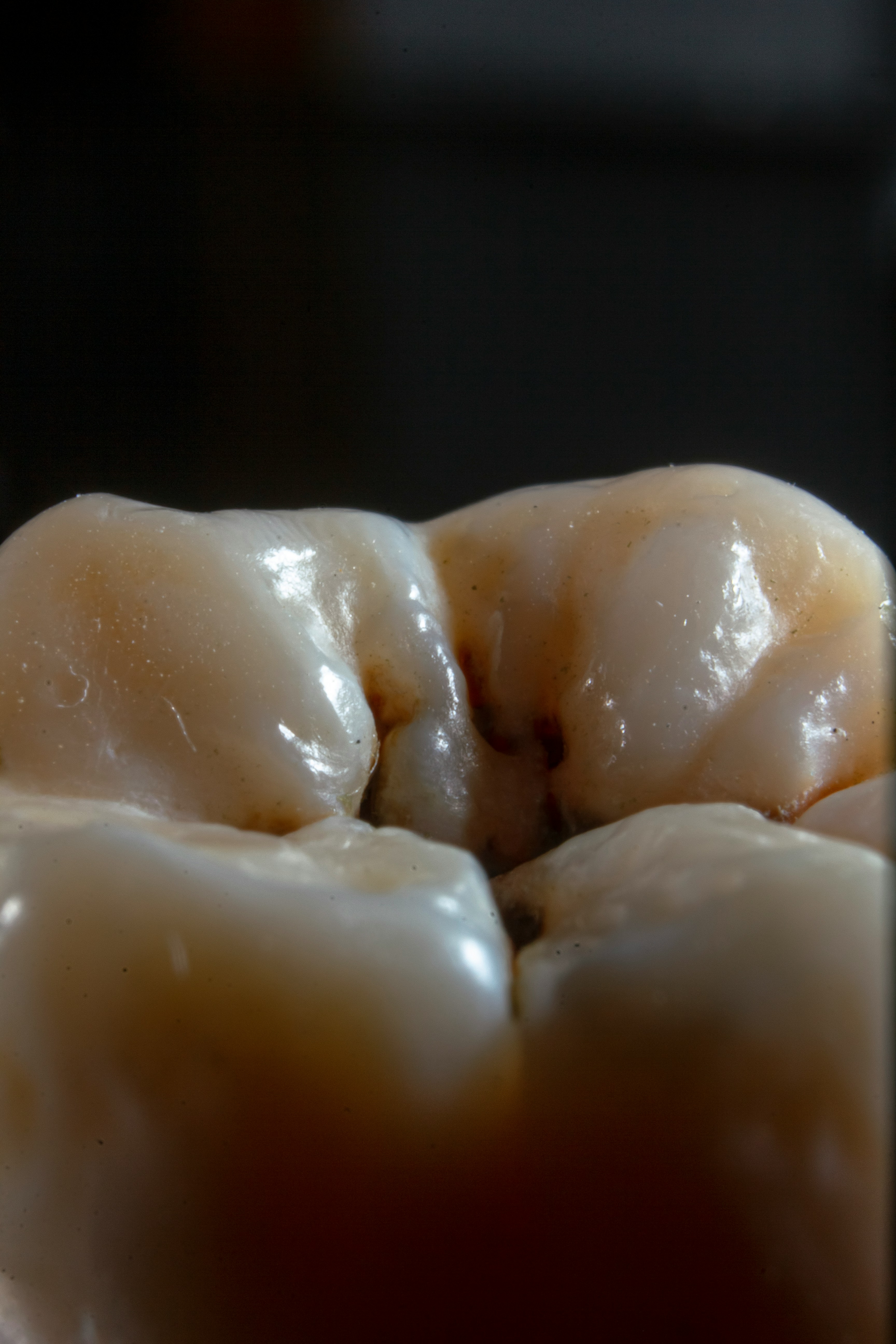 Cavities: What Causes Them and How to Prevent Them