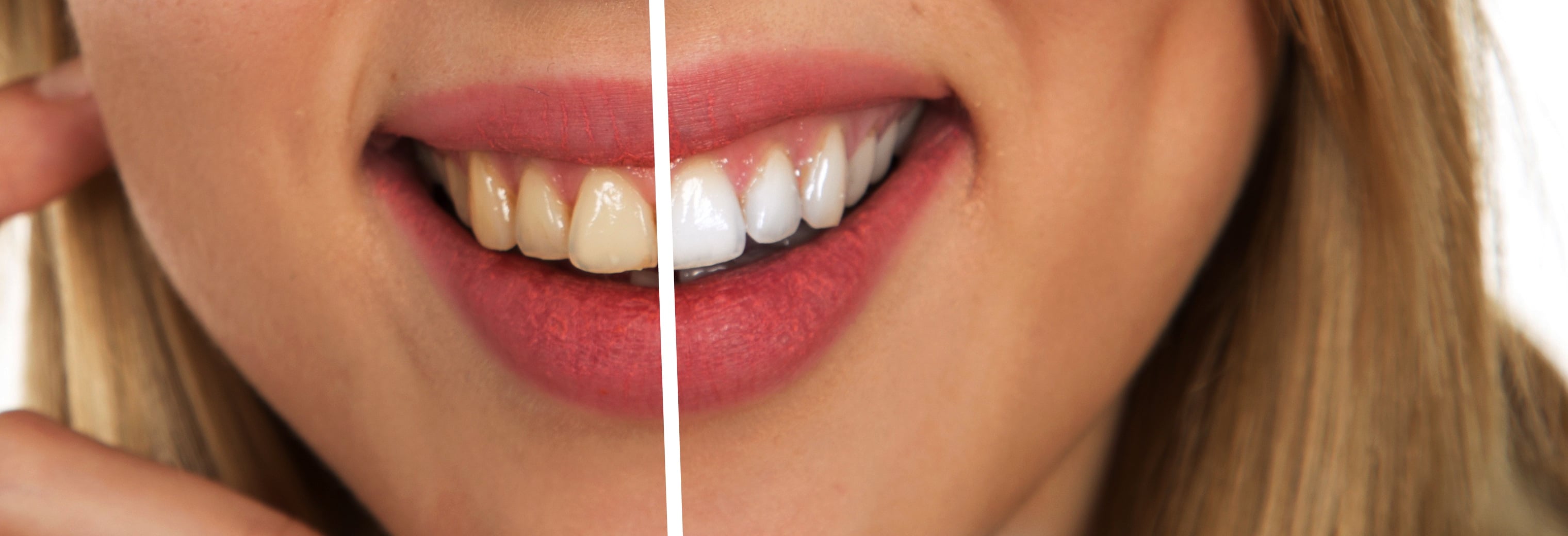 Teeth Whitening: What to Know Before You Brighten Your Smile