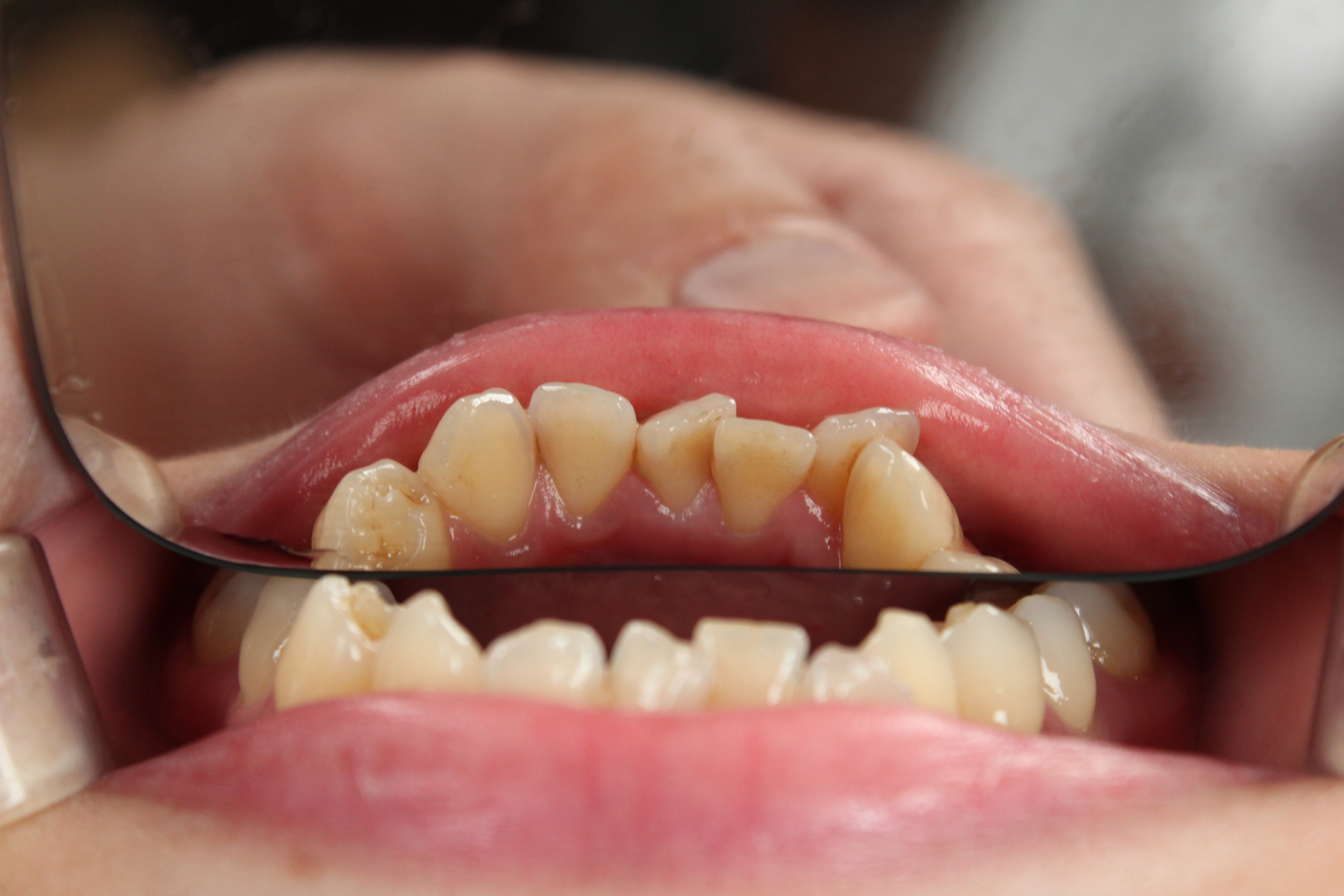 Crooked teeth: when braces or aligners are worth discussing