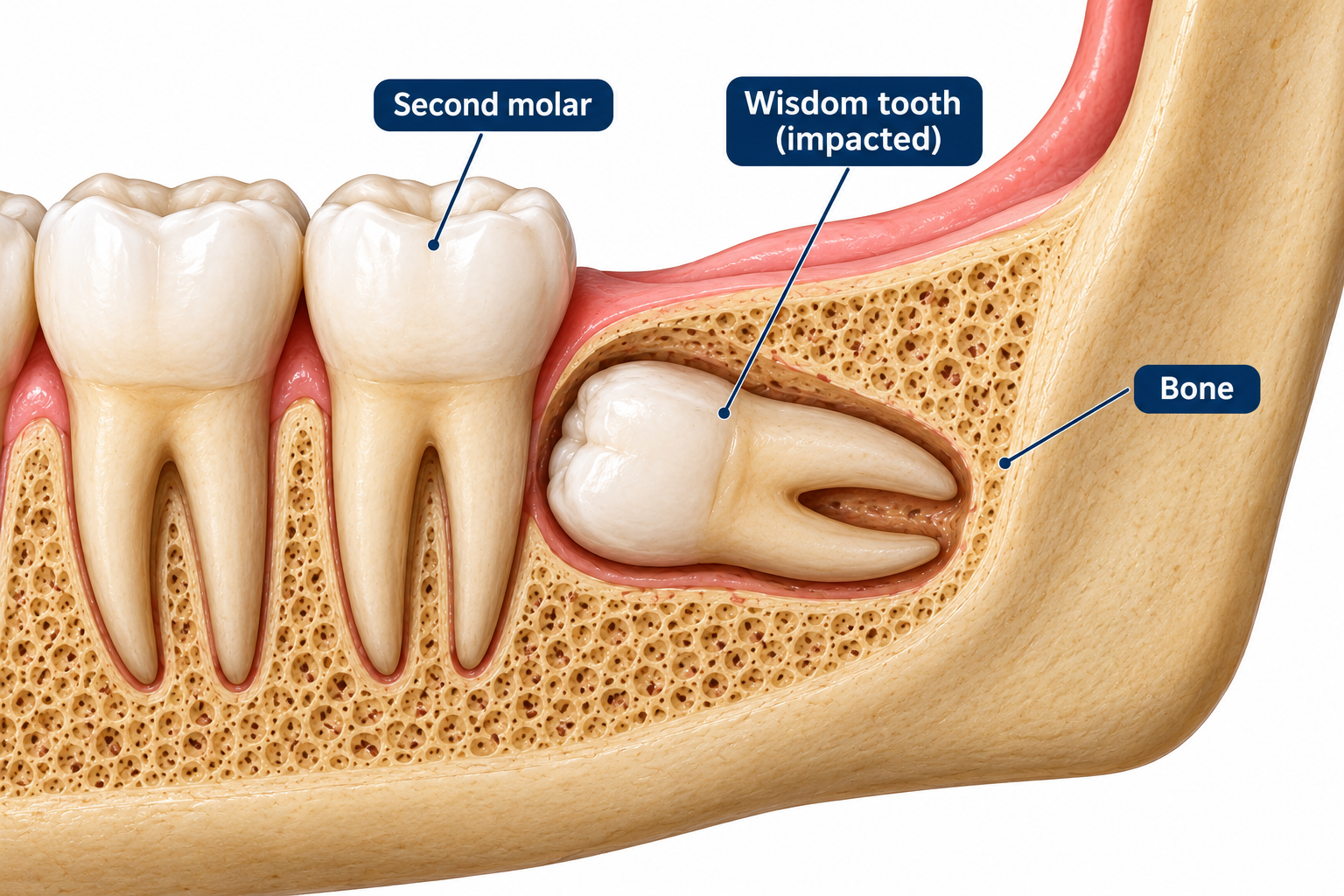 Is wisdom-tooth pain normal?